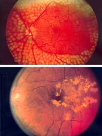 The eye of a patient with diabetes retinopathy after having laser photocoagulation (top). The eye of a patient with diabetes retinopathy after treatment for macular edema (or swelling of the macula) (bottom).