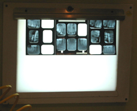 X-rays such as the one shown give Dr.Tynecki a better view of the patient's mouth and aid in diagnosis and treatment decisions.