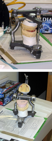 An articulator with a dental impression before treatment (above) and the new denture made from the impression (below)